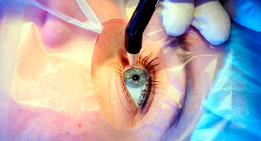 Лазерное лечение глаукомы